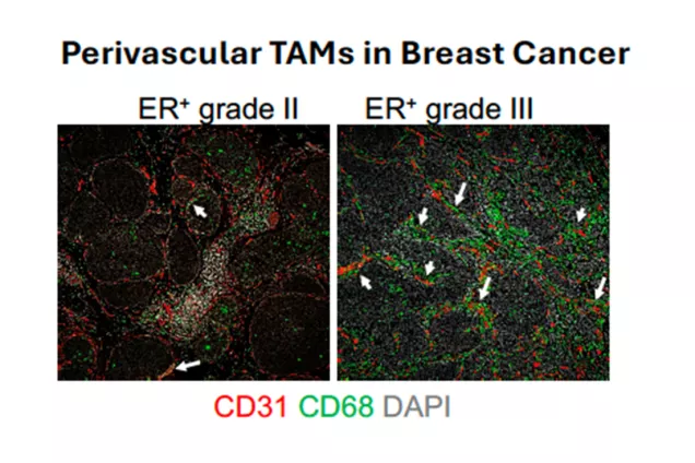 Micro image showing different states of a breast cancer tumor.